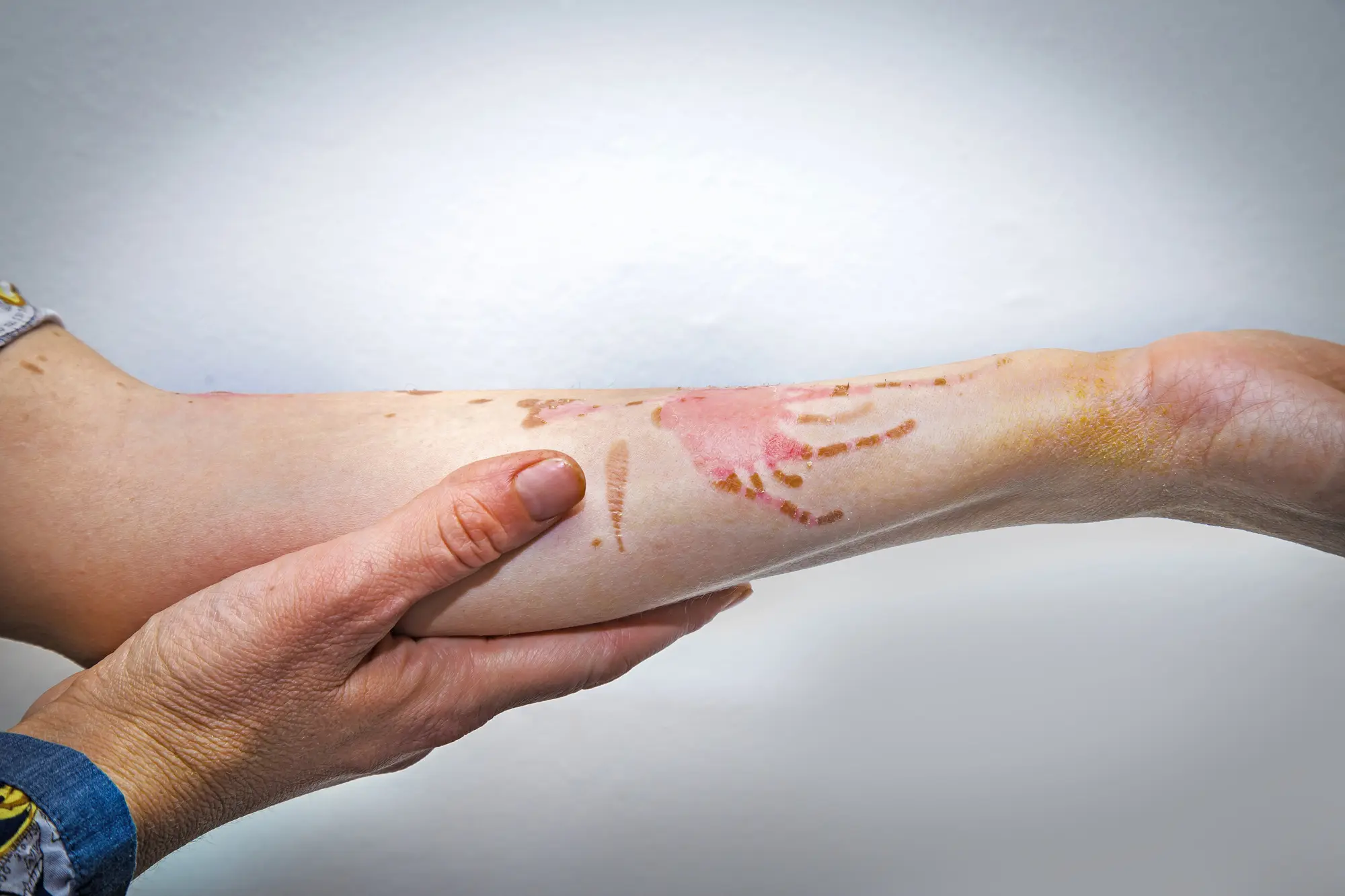 how-to-tell-if-a-wound-is-healing-or-infected-osf-healthcare