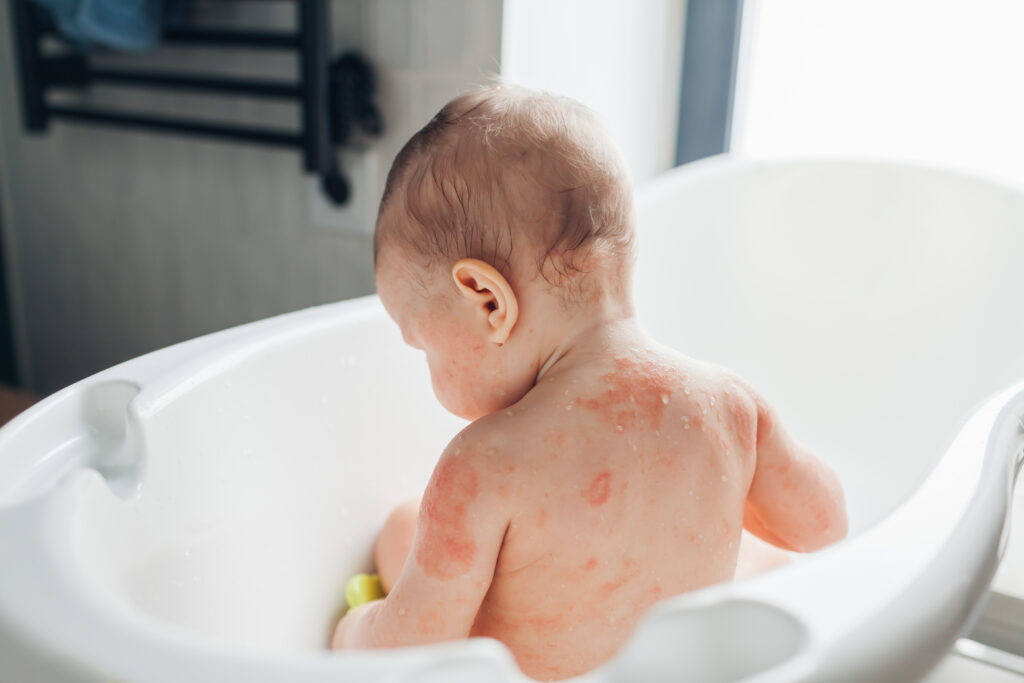 Coastal Baby Rash