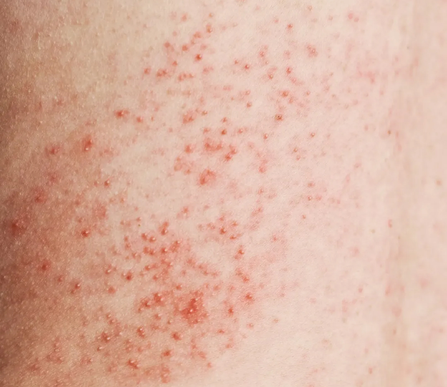 Heat Rash Table